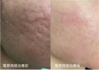 電漿飛梭