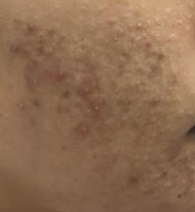 白頭粉刺