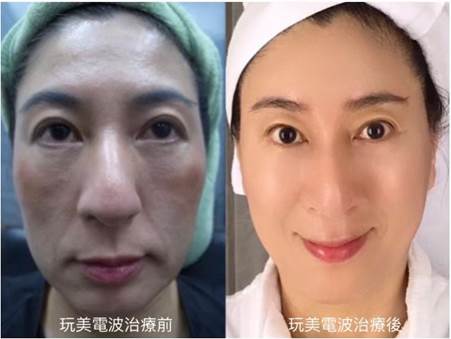 Oligio X超玩美電波案例照片,顯示治療前後的明顯改善效果,患者面部皮膚緊緻光滑,皺紋減少,整體膚質提升