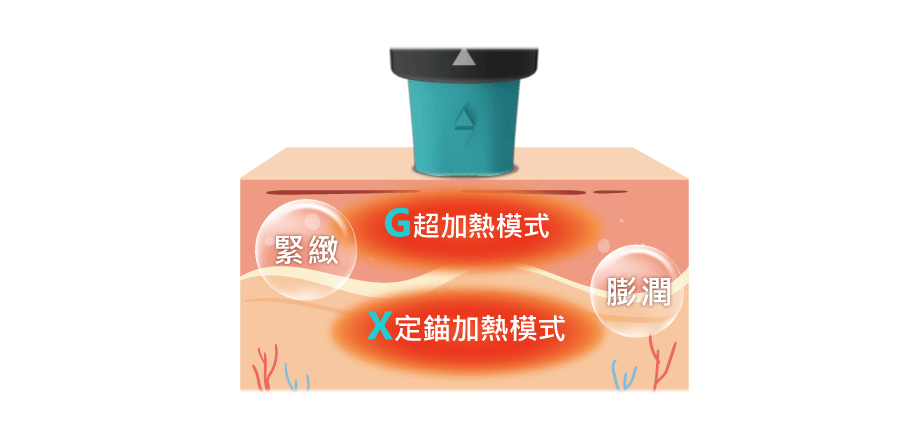 GXG超玩美模式治療過程插圖,設備圖示顯示治療步驟,圖中包含中文說明文字,背景為明亮診所環境,氛圍專業且安心,畫面傳達細緻關懷與科技感